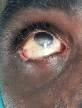 Clinical photograph demonstrating corneal opacity.